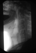 6-5-1d- X-ray of barium swallow.gif