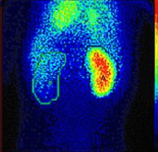6-5-2e- Gamma image of kidneys.png