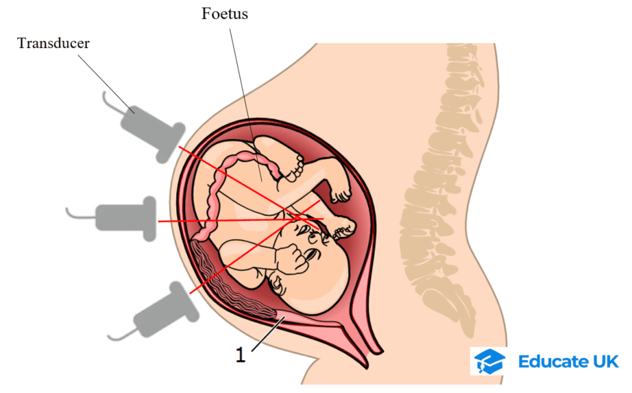 6-5-3c- Ultrasound B-scan.png