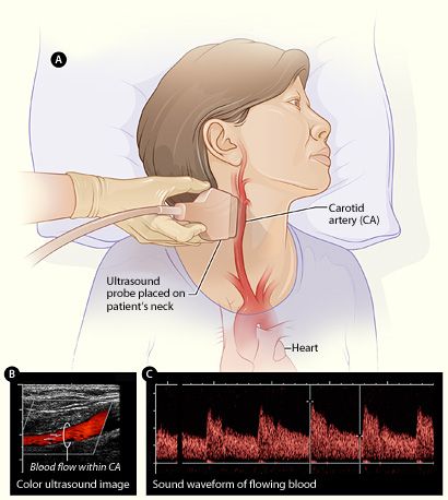 6-5-3g- Doppler ultrasound.jpg